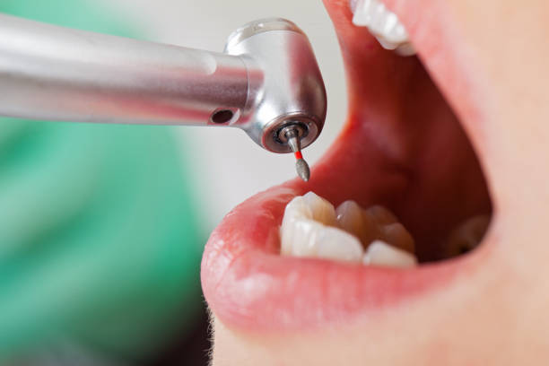 Best Emergency Tooth Extraction in Brunswick, NC